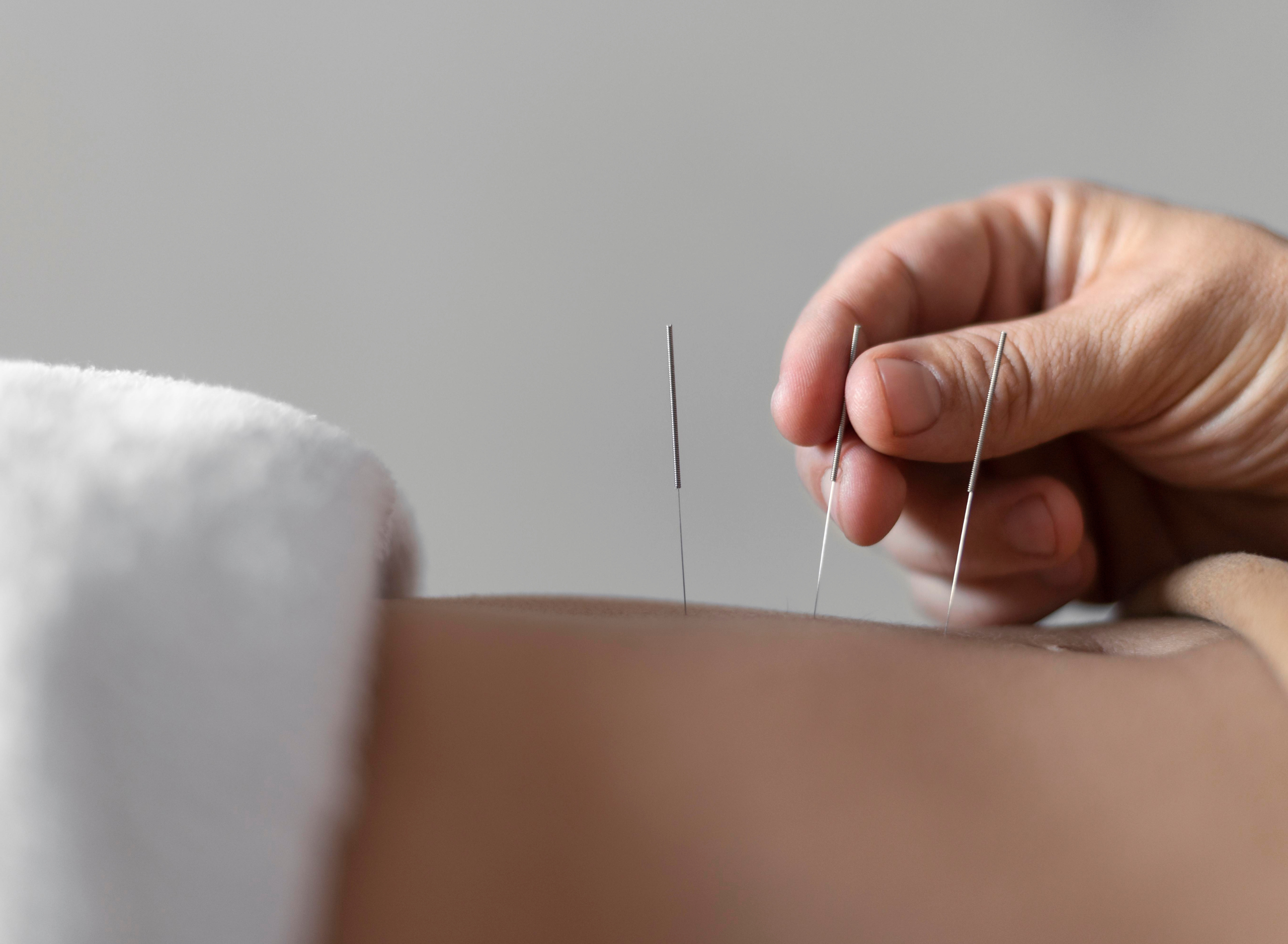 Puede la acupuntura aliviar el dolor de espalda?